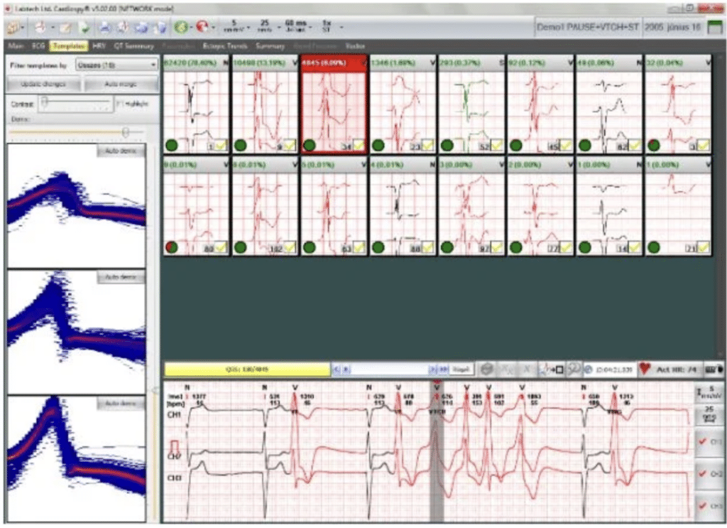holter ekg
